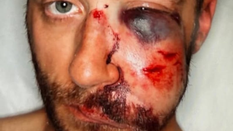 Shoplifting suspect accused of beating Tucson police officer with canned food